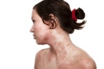 Лечение атопического дерматита у детей гомеопатией