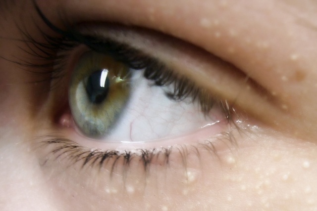 Белые точки вокруг глаз у детей