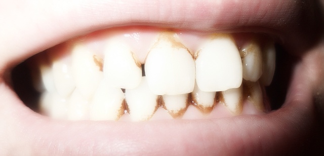Зуб болит темная полоска