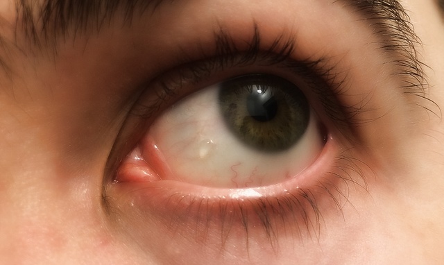 Жировик на сетчатке глаза