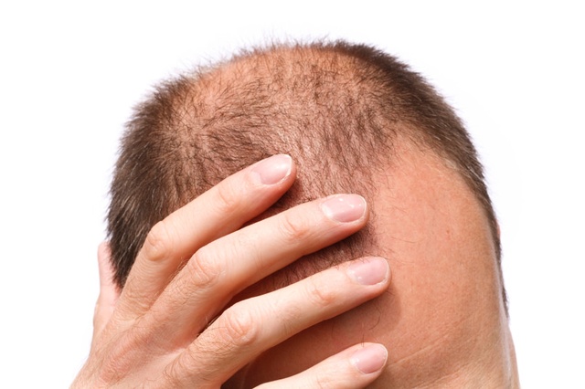 Как вылечить выпадение волос гомеопатией thumbnail
