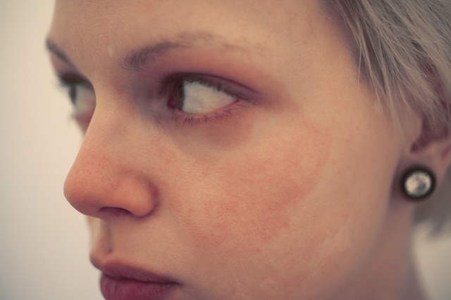 Гомеопатия от шелушения кожи на лице