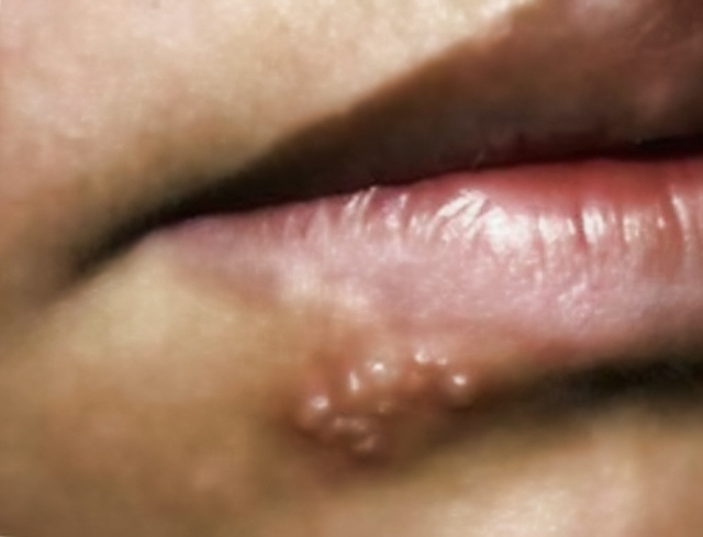 Гомеопатия от герпеса на губах у детей thumbnail